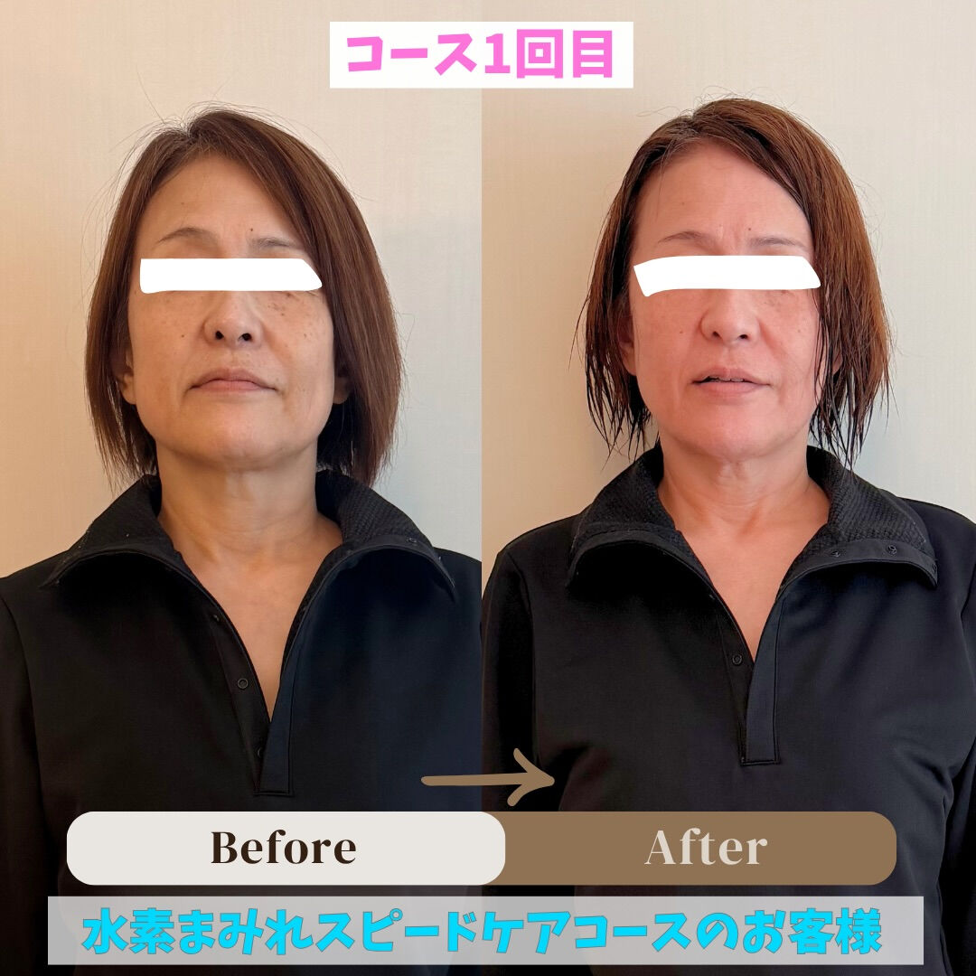【水素まみれスピードケアコース】の
